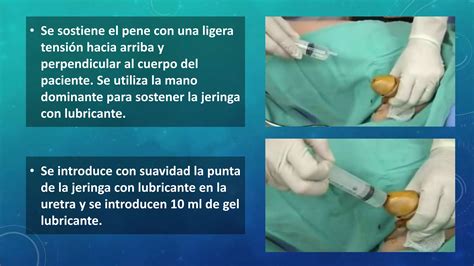 sonda vesical mujer real|Sonda Foley: Tipologías, características y métodos de。